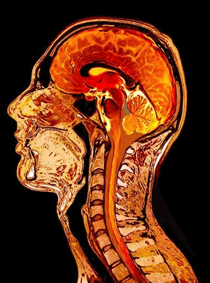 Image: Colored magnetic resonance imaging (MRI) scan of a normal brain (photo courtesy of Sovereign, ISM). Image: Colored magnetic resonance imaging (MRI) scan of a normal brain (photo courtesy of Sovereign, ISM).